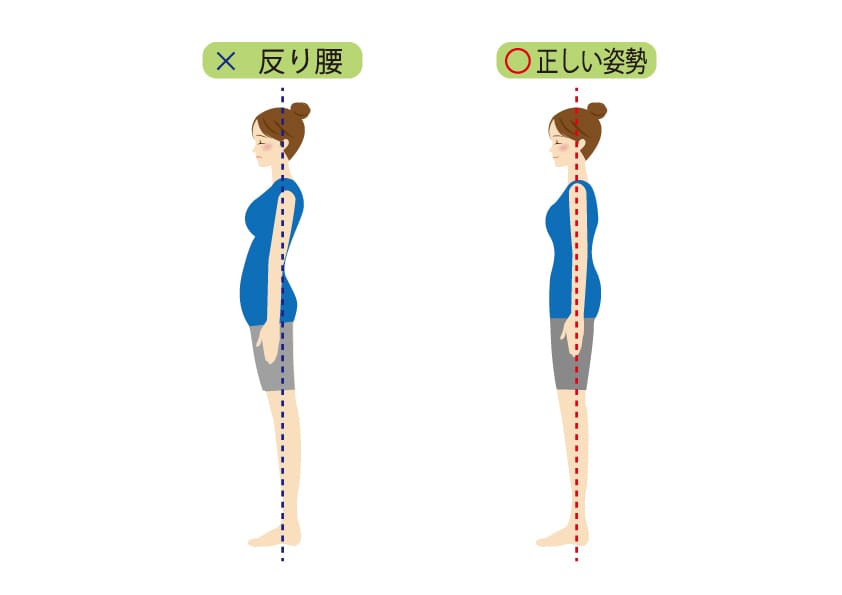 反り腰・骨盤前傾が見られる不良姿勢のイラスト